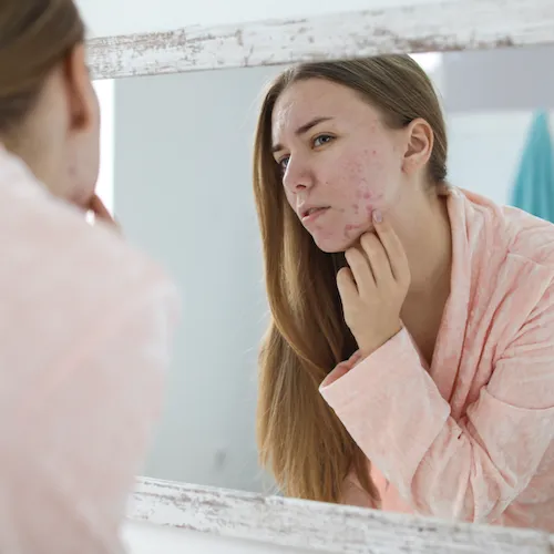 your acne fungal